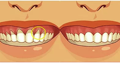 Reguliariai įtrinkite šį aliejų į dantenas ir pas odontologus lankysitės žymiai rečiau